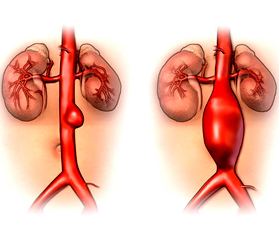 Aneurisma de Aorta