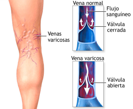 Enfermedades Ectasiantes de las Venas