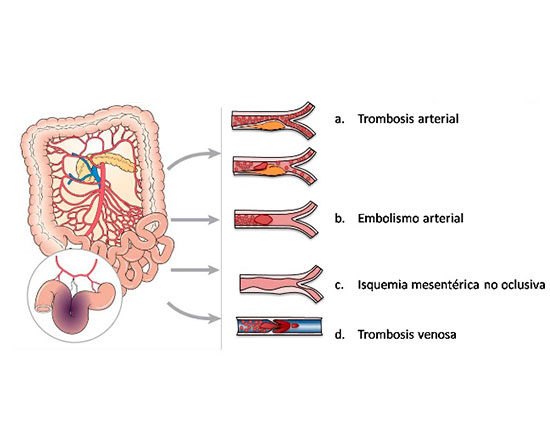 Isquemia Mesentérica Aguda Crónica