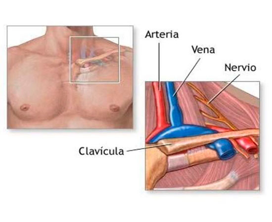 Síndromes Neurovasculares del Opérculo Torácico