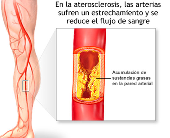 Síndromes Vasomotores y Mixtos